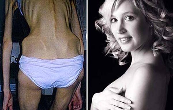 Истории девушек победивших анорексию, фотографии девушек анорексия до и после