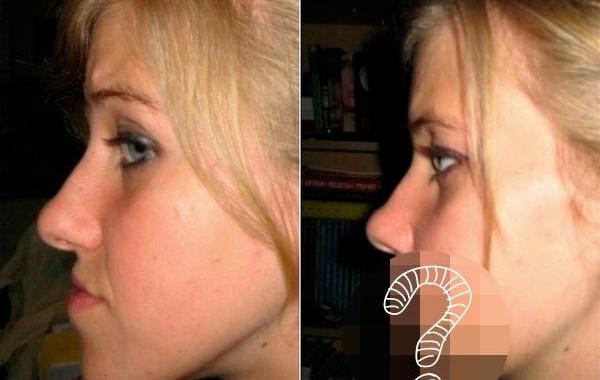 до и после челюстной хирургии, до и после пластической операции на челюсти, девушка после операции на челюсти