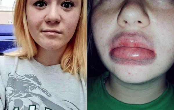 губы как у Кайли Дженнер,#kyliejennerchallenge, экстремальное увеличение губ, засовывают губы в маленькие баночки, увеличение губ отек