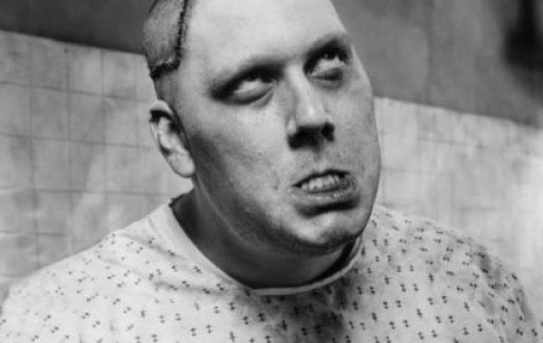 факты о лоботомии, лоботомия, вся правда о лоботомии