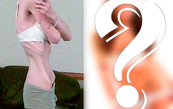 Меган Армер, Megan Armer, анорексичка стала моделью, от анорексии и стала моделью, девушка победила анорексию