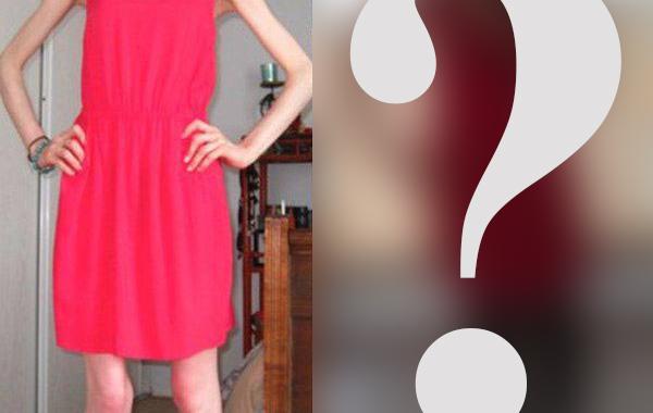 девушка после анорексии, девушка вылечилась от анорексии, девушка набрала вес после анорексии