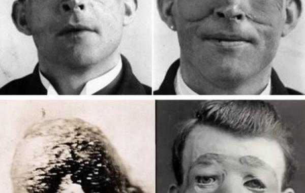 7 историй людей, которые перенесли первые в мире пластические операции