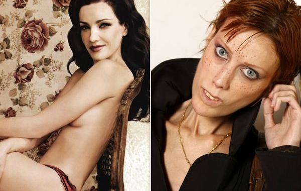 умершие от анорексии, истории об анорексии