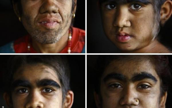 Семья с «синдромом оборотня»,гипертрихоз, лазерная эпиляция 