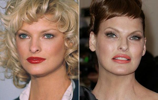 модели с неудачной пластикой, модели испортившие лицо пластикой