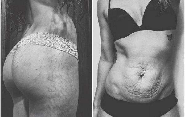 Instagram Love Your Lines, инстаграм растяжки, полюби свои растяжки