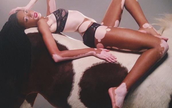 Шантель Винни модель с нарушением пигментации кожи, Chantelle Winnie