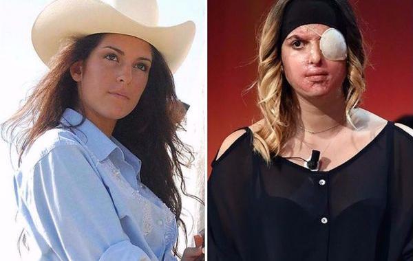 девушки облитые кислотой, девушки до и после того как их облили кислотой