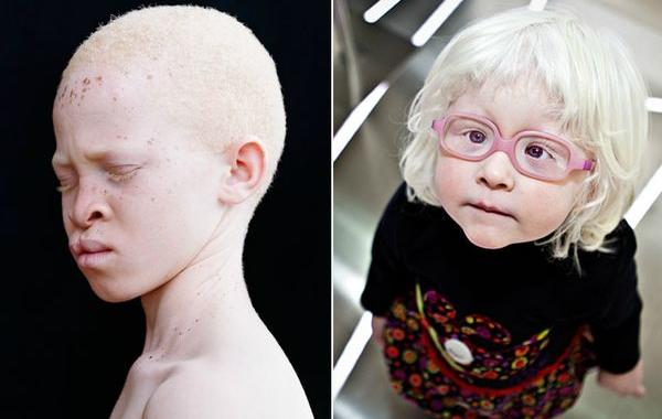 люди-альбиносы, люди с альбинизмом