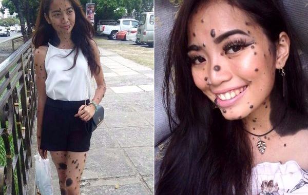 Эвита Патси Эдгар Делмундо, девушка с родинками на лице и теле