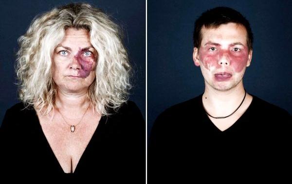 Портреты людей с родимыми пятнами, люди с родимыми пятнами,  Линда хансен, Nevus Flammeus