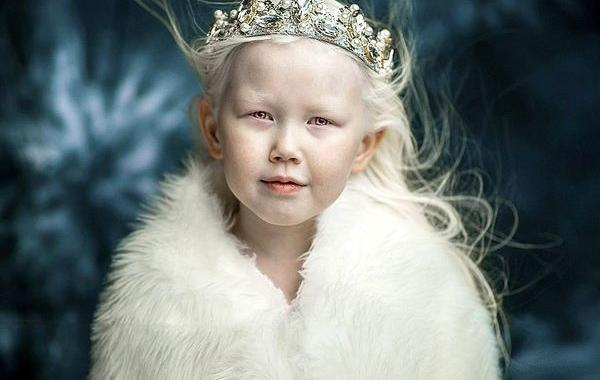 Нарьяна из Якутии, 8-летняя девочка-альбинос, Нарьяна альбинос