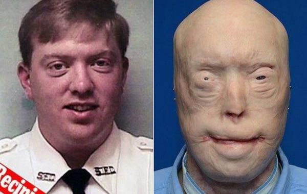 Пэт Хардисон, Pat Hardison, Дэвид Роудбах, David Rodebaugh, пересадка лица, самая крупная операция по пересадке лица, пересадка лица 2015