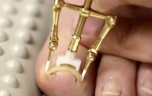 Makizume Robo, изобретение против вросшего ногтя, изобретение против вросших ногтей