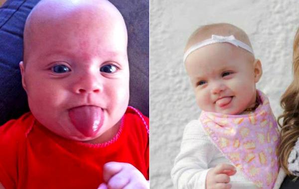 Оуши Варни, Ocea Varney, девочка родилась с большим языком, большой язык не закрывается рот, синдром Беквита-Видеманна