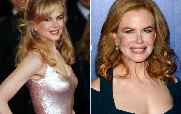 знаменитости коловшие себе ботокс, неудачная пластика знаменитостей