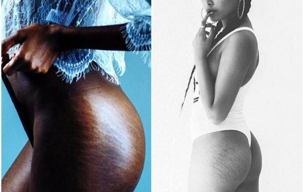 Полюби свои линии, полюби свои растяжки, женщины размещают фотографии своих растяжек, #LoveYourLines, Крисси Тейген