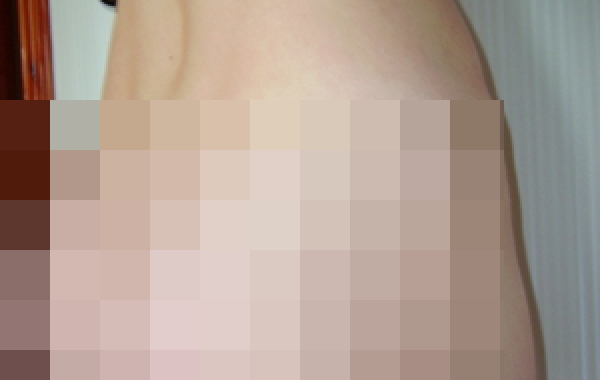 Крайне неудачная установка ягодичных имплантов в одной из московских клиник