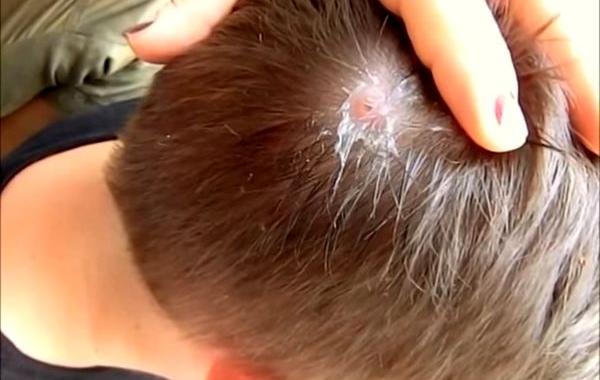 извлечение из головы личинки овода, личинка овода в голове, извлечение личинки овода видео, личинка овода под кожей