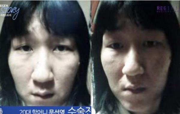 Пластическая хиргия в Южной Корее и превращение Мун Сан Янг, Moon Sun Young