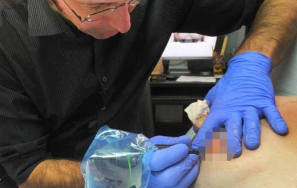 Винсент "Винни" Майерс Vincent "Vinnie" Myers, татуировки сосков, рак молочной железы