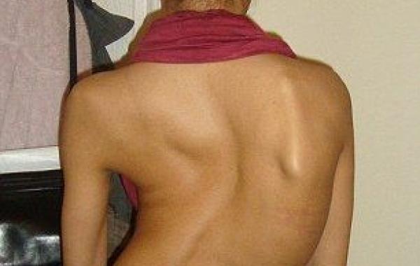 Айша Джонс, Ayesha Jones, девушка с кривой спиной стала моделью, страшный сколиоз