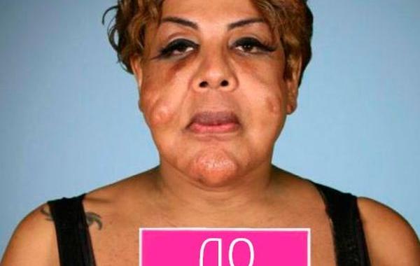 Раджи Наринесинг, Rajee Narinesingh, Раджи Наринесинг до и после, Раджи Наринесинг после восстановительной операции