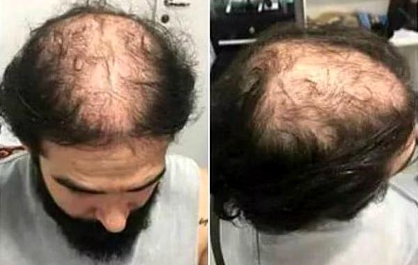 прятать лысину гулька, спрятали облысение гулька