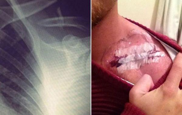 кольцо их хирургической пластины, пластина в ключице кольцо