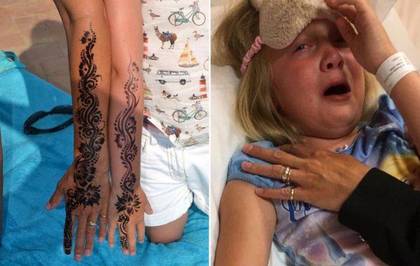 Братья получили страшные ожоги от временной татуировки хной, сделанной в Египте