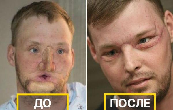 операции по пересадке лица, развитие операций по пересадке лица, лицевая трансплантация