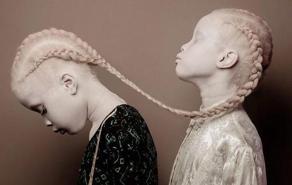 Темнокожие близнецы альбиносы, Лара и Мара Бавар, близнецы альбиносы из Бразилии, Lara Mara Bawar