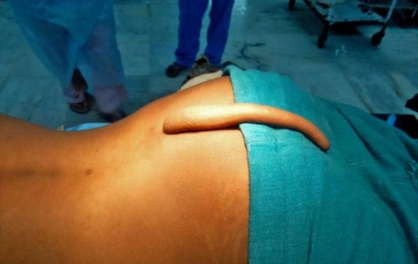 подростку удалили 18-сантиметровый хвост, 18-сантиметровый хвост у человека, индийский подросток с хвостом