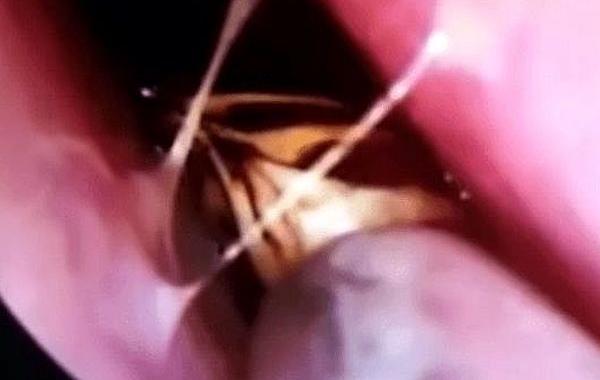 таракан в носу, таракан в носу видео