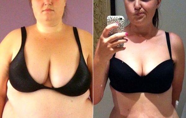 похудела на 70 кг, осталась лишняя кожа после похудения, похудела живот остался