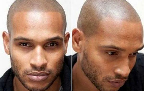 тату вместо лысины, новый способ избавиться от лысины, татуировка в виде волос на голове, татуировка вместо лысины