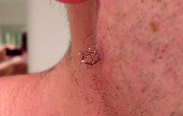 самый длинный вросший волос, извлечение самого длинного вросшего волоса, парень достал из лица самый длинный вросший волос