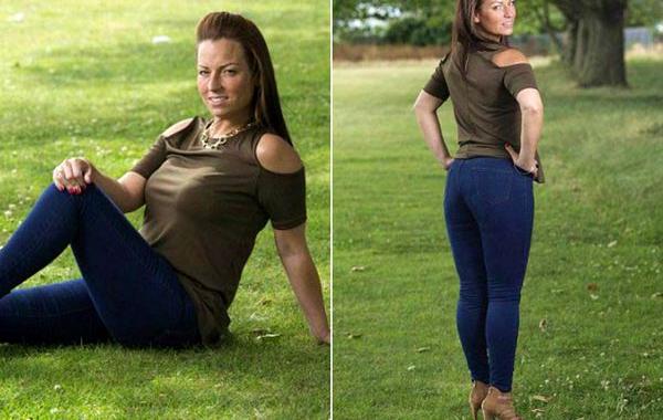 неудачная подтяжка ягодиц, неудачная пластическая операция