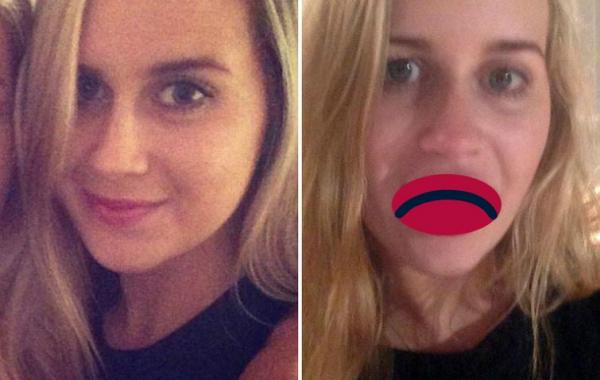 CandyLipz, CandyLipz до и после, губы после CandyLipz, Бриттани Форстер, Brittany Forster