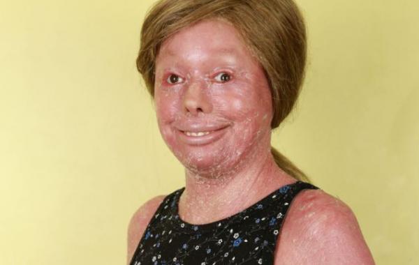 Хантер Стейниц hunter steinitz ихтиоз арлекина болезнь