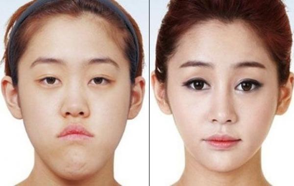 Пластические операции  Южная Корея до и после, фото
