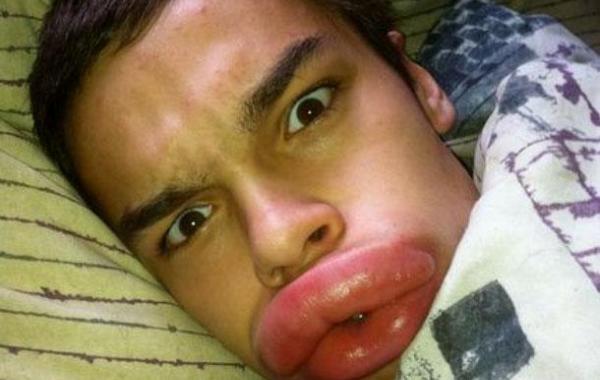 ботокс в губах, гламурные девушки, накаченные губы