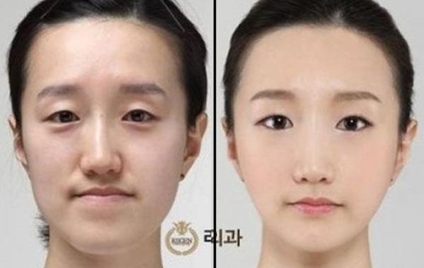 Пластические операции  Южная Корея до и после, фото