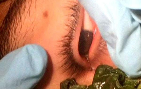 червь в глазу, врач достал червя из глаза, врач достал червя из глаза видео, червь в глазу базилик