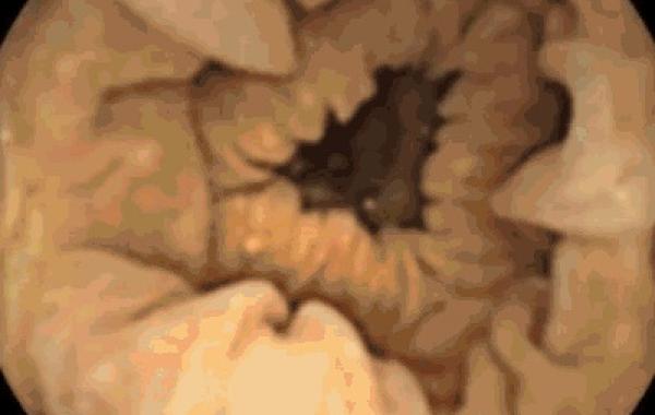 Прямой репортаж из толстой кишки. таблетка видеокамера колоноскопия