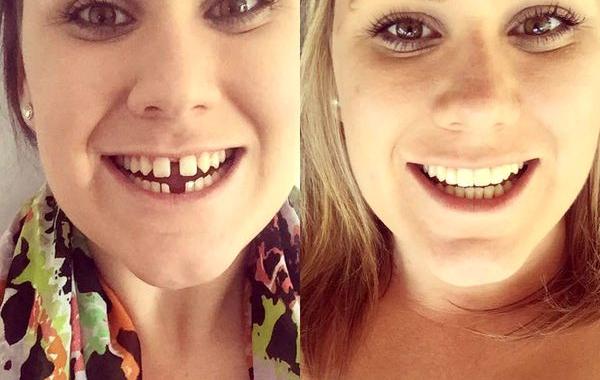 до и после брекетов, люди с брекетами 