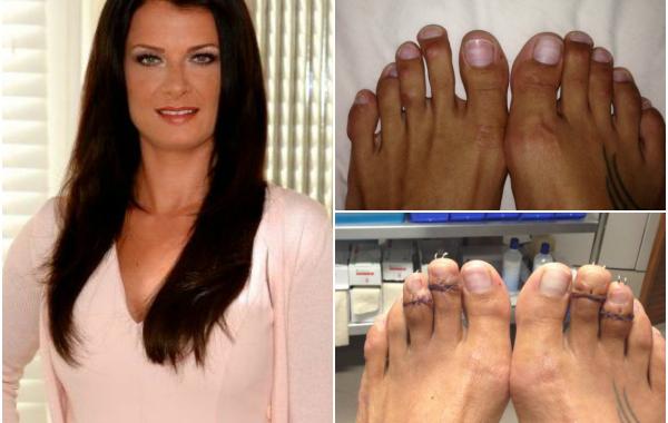 Ноги женщин до и после того, как они укоротили пальцы на ногах, чтобы лучше смотреться в туфлях на каблуках