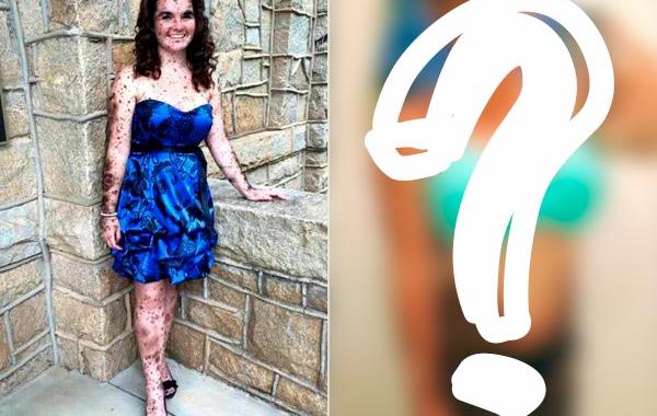 Сьера Суоринген, Ciera Swaringen, сотни родинок по всему телу, сотни родимых пятен по всему телу, врожденные меланоцитарные невусы