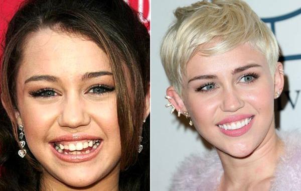 звёзды в брекетах, звёзды с брекетами, улыбки звёзд, зубы знаменитостей 